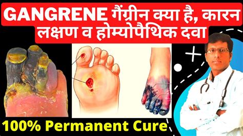 गैंग्रीन Gangrene Natural Homeopathy Medicine For Gangrene And