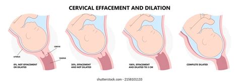 Vaginal Delivery Diagram