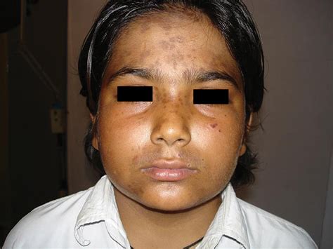 actinic  dermatology