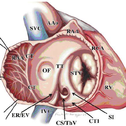 Typical Atrial Flutter The Wave Of Activation Travels In A Counter