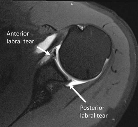 Arthroscopic Labral Repair Using Knotless Suture Anchors In The Setting Of A 270° Labral Tear Of