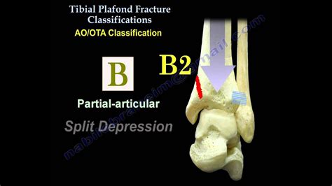 Pilon Fracture Tibial Plafond Fracture Everything You Need To Know