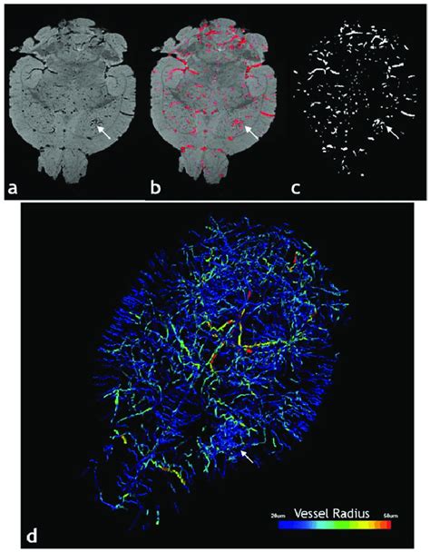 Segmentation Of The Vasculature From Mmri Data Image Processing Steps