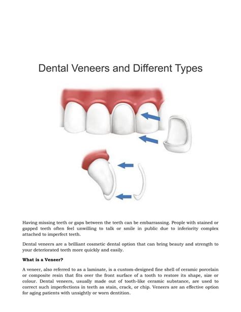 Dental Veneers And Different Types Pdf