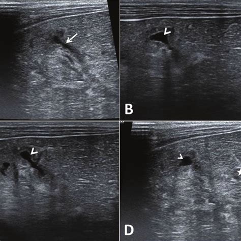 Ultrasound shows altered coarse echotexture of liver with architectural... | Download Scientific ...