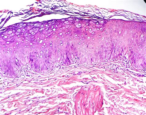 Acquired Epidermodysplasia Verruciformis In Renaltransplant Recipients