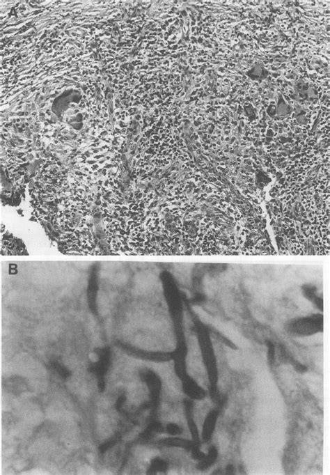 Sections Of Subcutaneous Granulation Tissue Excised From Download Scientific Diagram