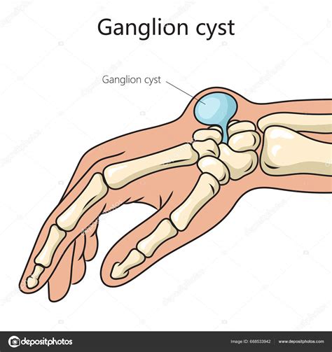 Ganglion Cyst Cure A Complete Treatment Guide To Ganglion 57 Off