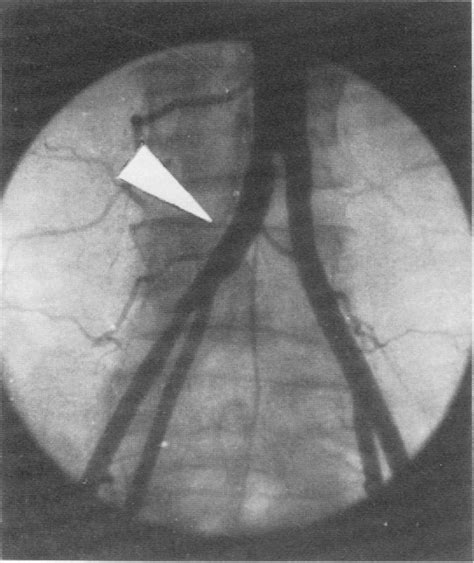 Figure 1 From Iliac Arteriovenous Fistula Complicating Lumbar