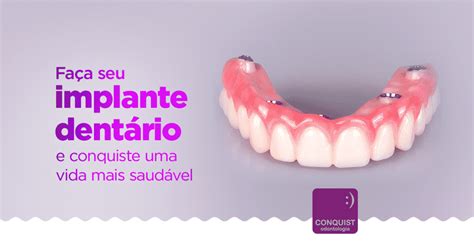 O que são os Implantes Dentários l Conquist Odontologia