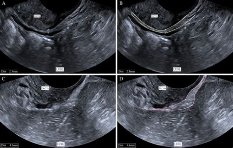 Ultrasound Characteristics And Scanning Techniques Of Uterosacral