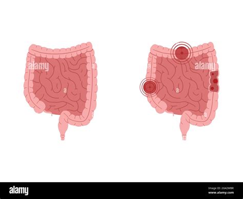 Ilustraci N De Vector Plano De Intestinos E Intestinos Sanos Con