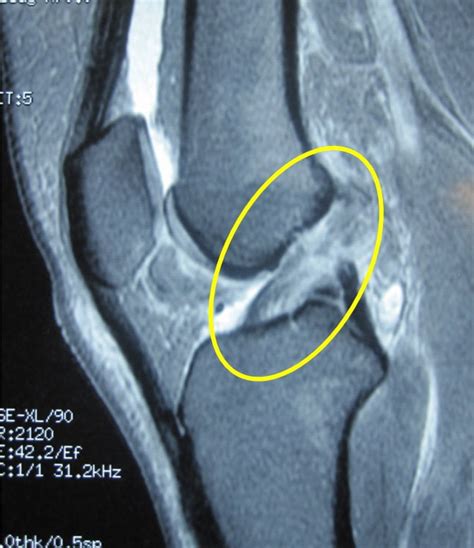 Diagnóstico da Ruptura do Ligamento Cruzado Anterior LCA