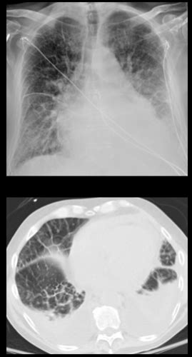 Imaging Of Diffuse And Interstitial Lung Disease Owens Flashcards