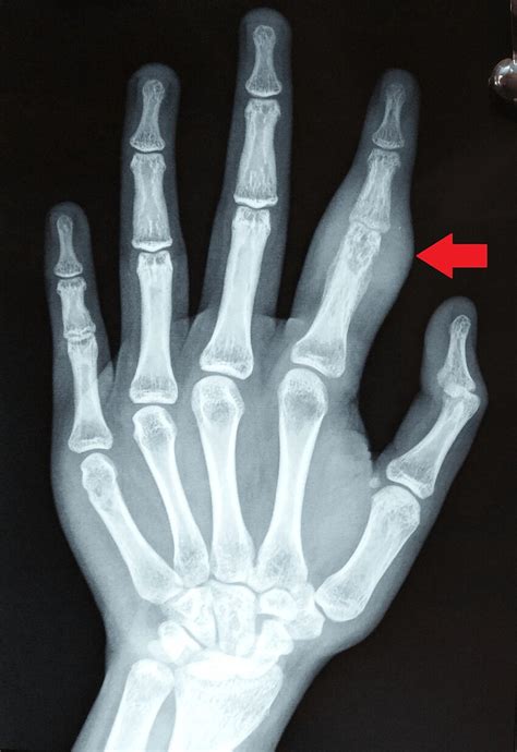 Plain Radiographs Of The Left Hand Postero Anterior View Showing Soft