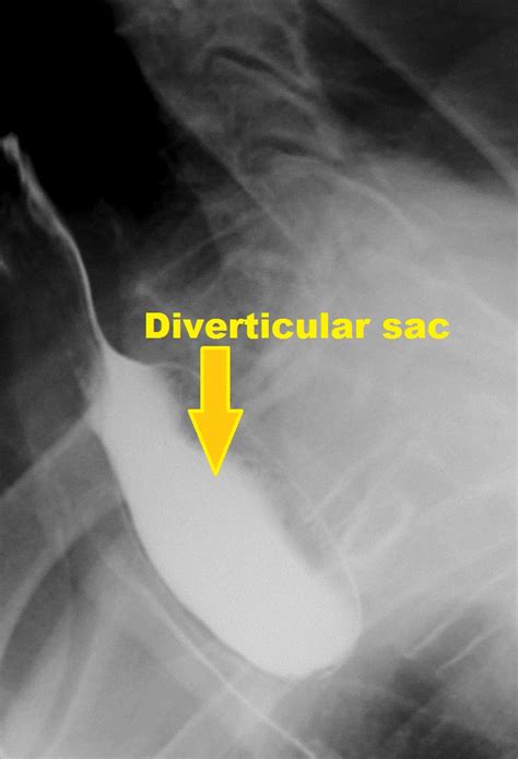 Zenker's diverticulum x ray - wikidoc