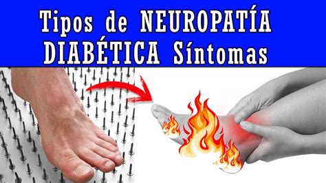 Tipos De Neuropat A Diab Tica Causas Y S Ntomas Youtube