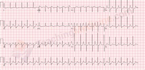 Accelerated Junctional Rhythm