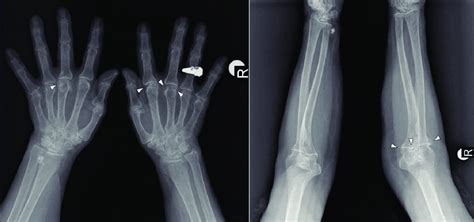 Radiographs Showing Narrowing In The 2 Nd And 3 Rd Mcp Joints Space Download Scientific