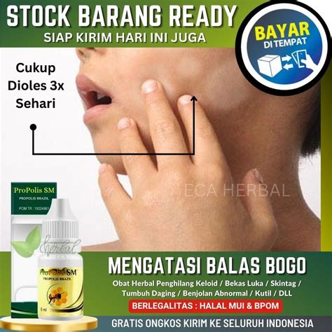 Jual Obat Tetes Penghilang Panu Di Wajah Leher Punggung Sekujur