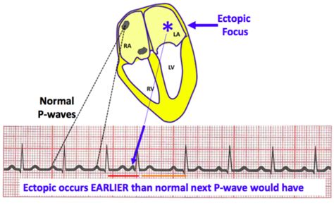 Chapter Ekg Atrial Dysrhythmias Chapter Ekg Junctional