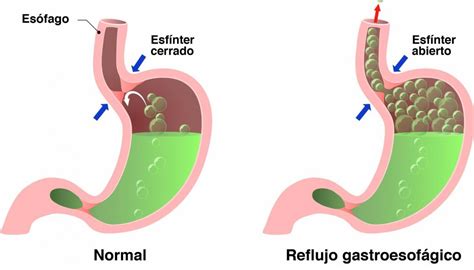 Reflujo Gastroesofágico