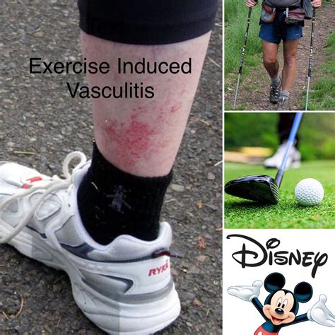 Exercise Induced Vasculitis Legs – Online degrees