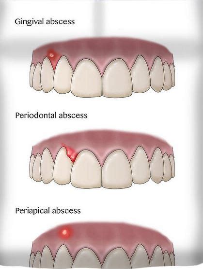 Abses Gigi : Penyebab – Gejala dan Penanganan - IDN Medis