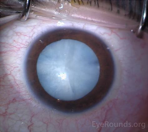 EyeRounds.org: Diabetic White Cataract