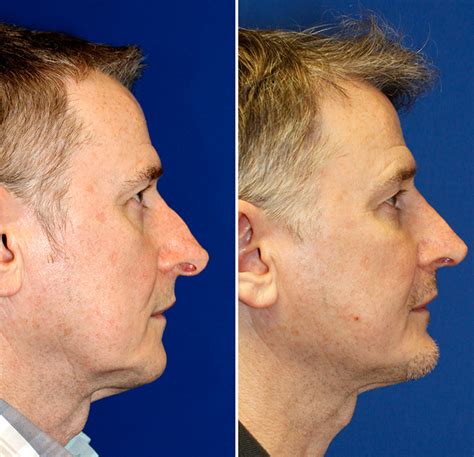 Before And After Photos Of Hanging Columella Repair Seattle Facial