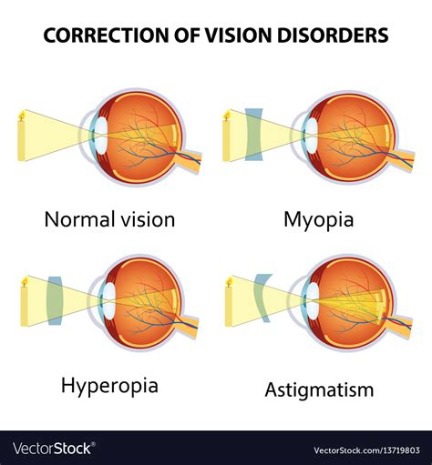 Correction of eye vision disorders by lens Vector Image