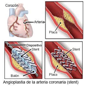 Colocaci N Del Stent Intravascular Coronario Care Guide Information En