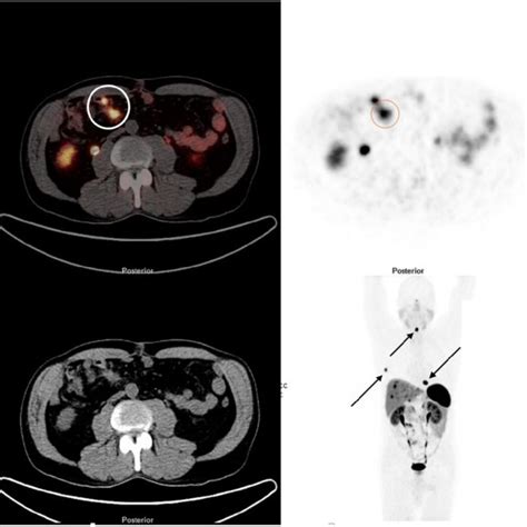 Ga Dotatate Pet Ct Demonstrating A Sbnen With Lymph Node Metastases