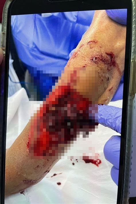 Shark Bite Wounds