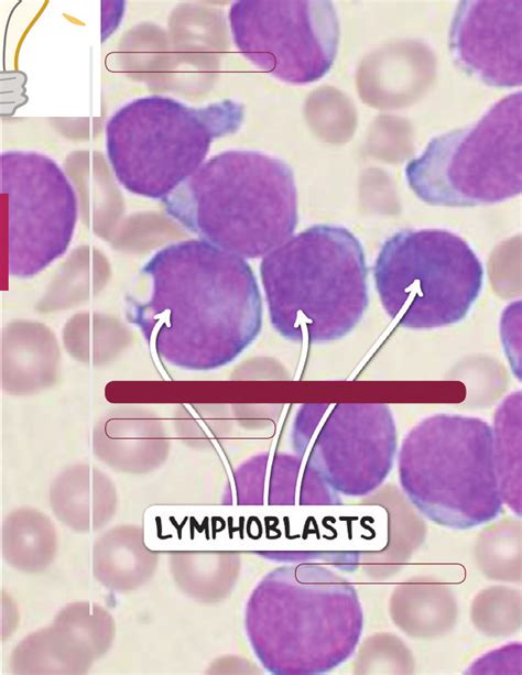 Leukemias Notes: Diagrams & Illustrations | Osmosis