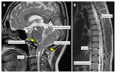 Hiccups Due To Chiari Type I Malformation Cmaj