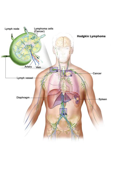 Hodgkin Lymphoma Cancer Treatments, & Symptoms - NHCancerClinics