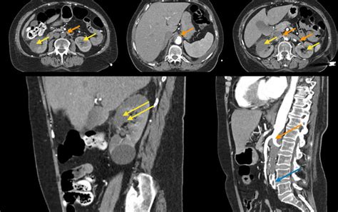 Case Yellow Arrows Ischemic Renal Lesions Orange Arrows Thrombotic