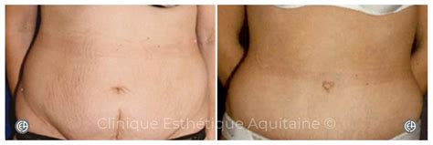 18 Cicatrice Abdominoplastie