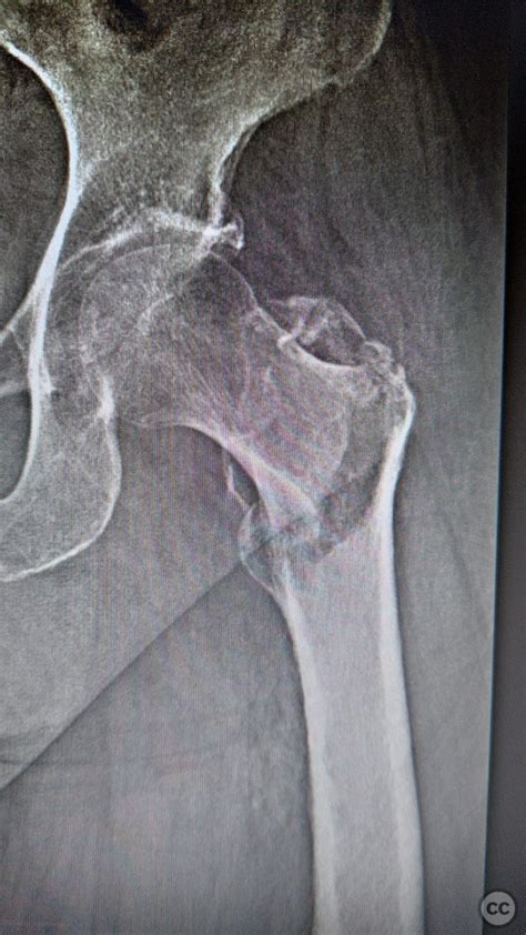 Basiservical Femur Fracture With Trochanter Major Fracture