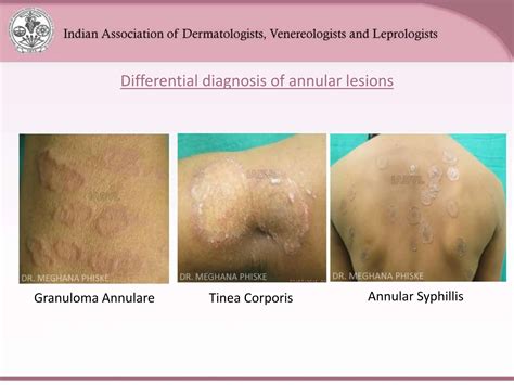 Leprosy Dermatology Microbiology Hansen Ppt