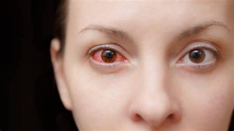 Protect Your Eyes From Conjunctivitis Expert Tips For Prevention And Care