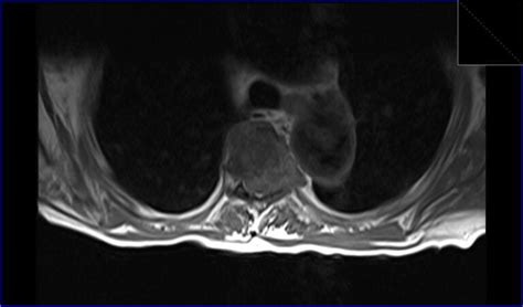 Metastatic spinal cord compression mri | Radiology article