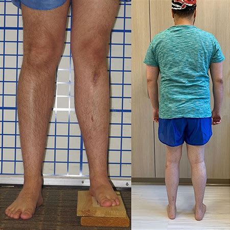 Leg Lengthening Surgery Body Builder