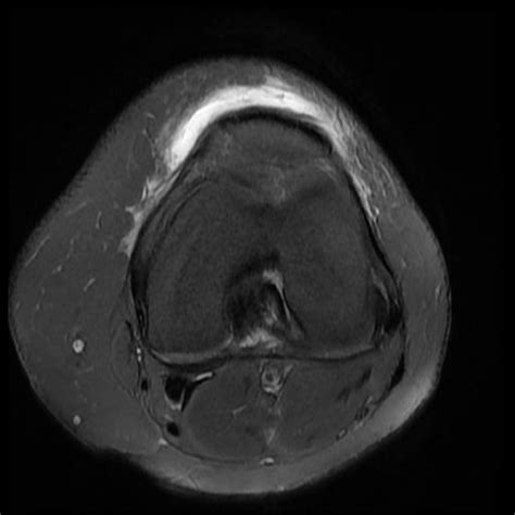 Prepatellar Bursitis Image Radiopaedia Org