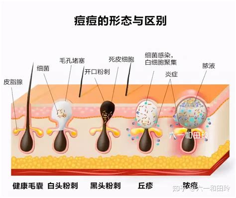 2个方法彻底解决胸前、后背长痘 知乎