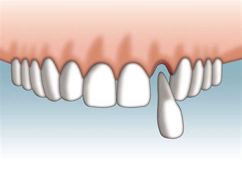 One Out Of 3 Teenagers Have A Tooth Accident In The Age Of 6 16 Broken