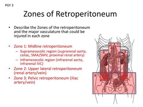 Retroperitoneal Hematoma Zones