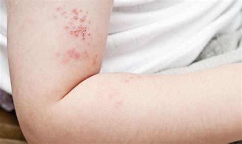 Demystifying Shingles Causes Symptoms And Treatments