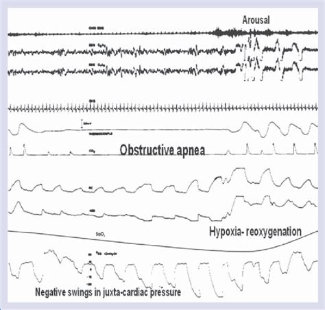 Acute Consequences Of Obstructice Sleep Apnea Osa An Example Of Osa